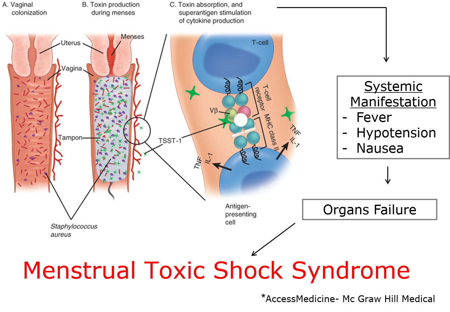 Uheldig landing nok Pathogenesis of menstrual Toxic Shock Syndrome — Centre International de  Recherche en Infectiologie