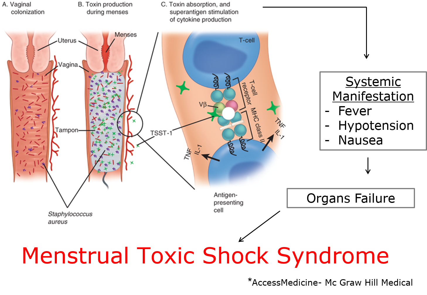 Menstrual toxic shock syndrome